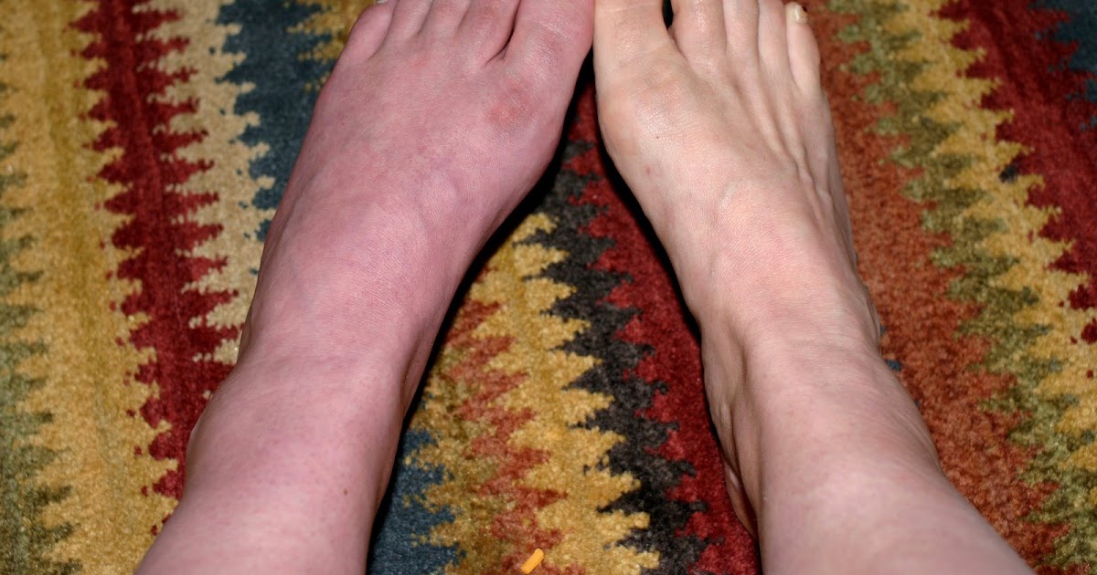 The G's The case of the curious purple foot