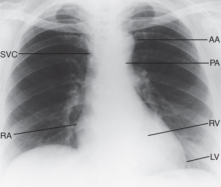 heart diseases Normal chest Xray