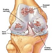      knee-arthritis.jpg
