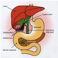 Cholesterol+gallstones+in+stool