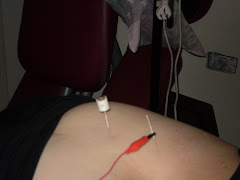 MOXIBUSTIÓN + ELECTROACUPUNTURA EN ZONA LUMBAR