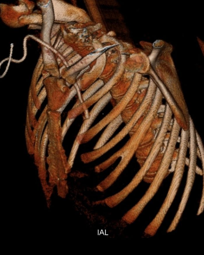 Bifid Ribs Medicalchemy Orthopaedics