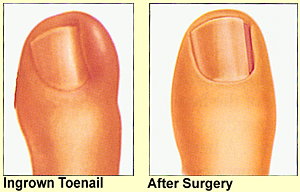 Ingrown Toenail before and after surgery