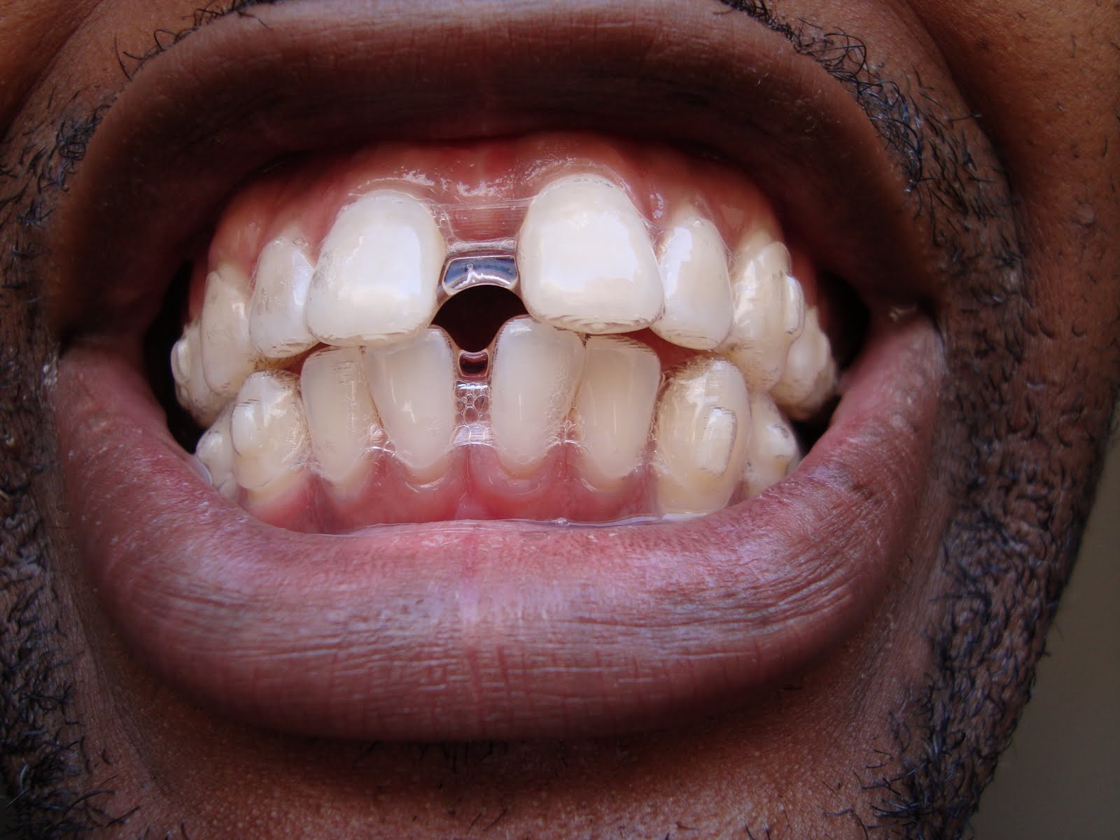 invisalign teeth ugly tray experience