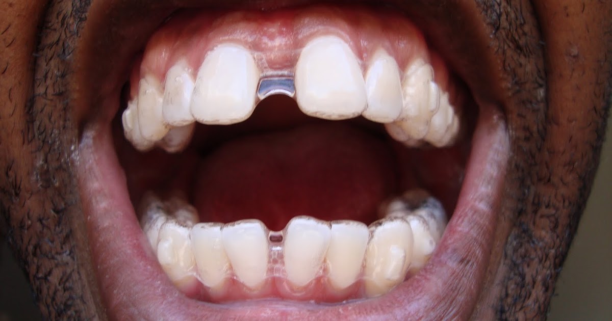 invisalign tray
