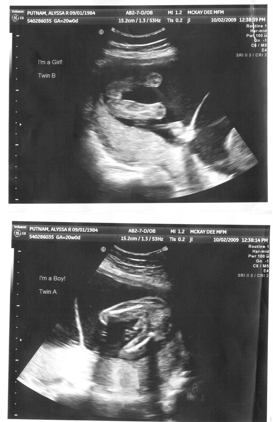 Determining sex at 20 week scan