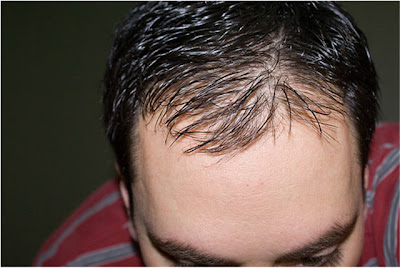 propecia hair loss