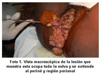Virus De Papiloma Humano En Hombres Tratamiento