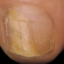 toenail-fungus-cures.jpg