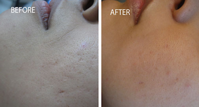 Topical steroids acne scars