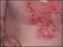 Burns usually take place