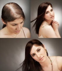 UNRAVEL THE MYSTERY BEHIND FEMALE HAIR LOSS