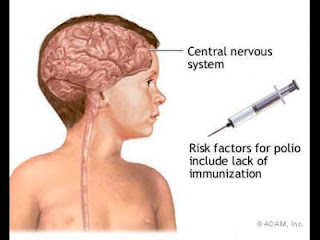 Informatii despre poliomielita (paralizia infantila)