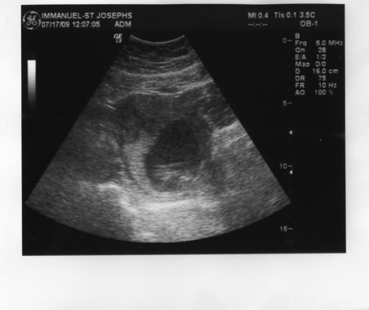 Ultrasound 15 weeks