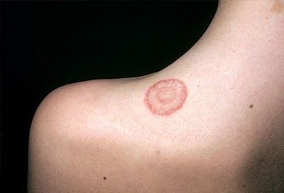 Ringworm On Humans