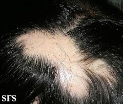 Alopecia Aretata