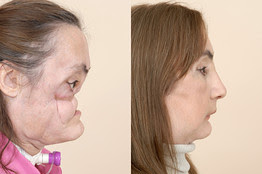 Connie Culp was the first lady ...