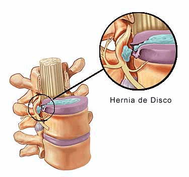 [herniate-disco.gif]