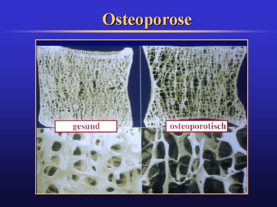 [osteoporose1.jpg]