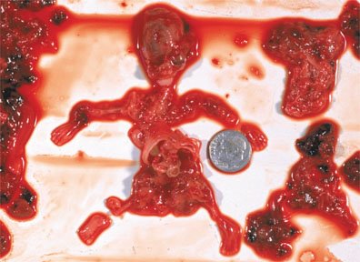 [aborted_9_week_fetus.jpg]