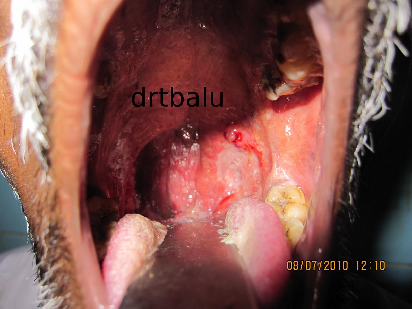 Enlarged Tonsils