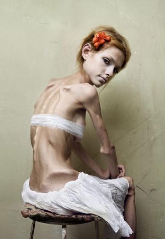 use the above image as Bulimia
