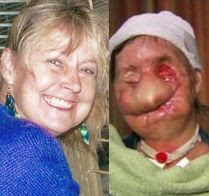 after chimp attack