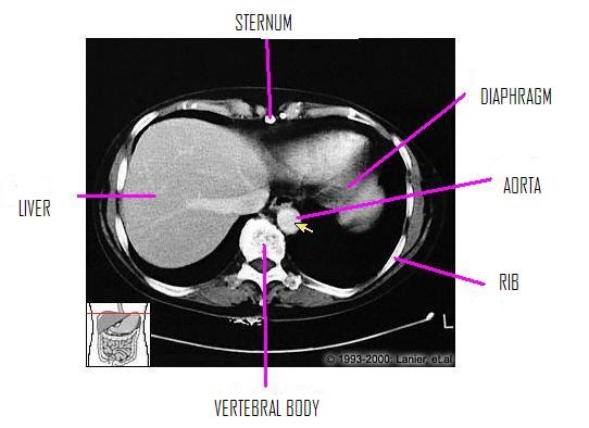 radiopaedia abdominal ct labeled