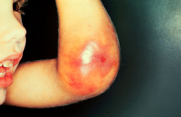 Image result for about hemophilia