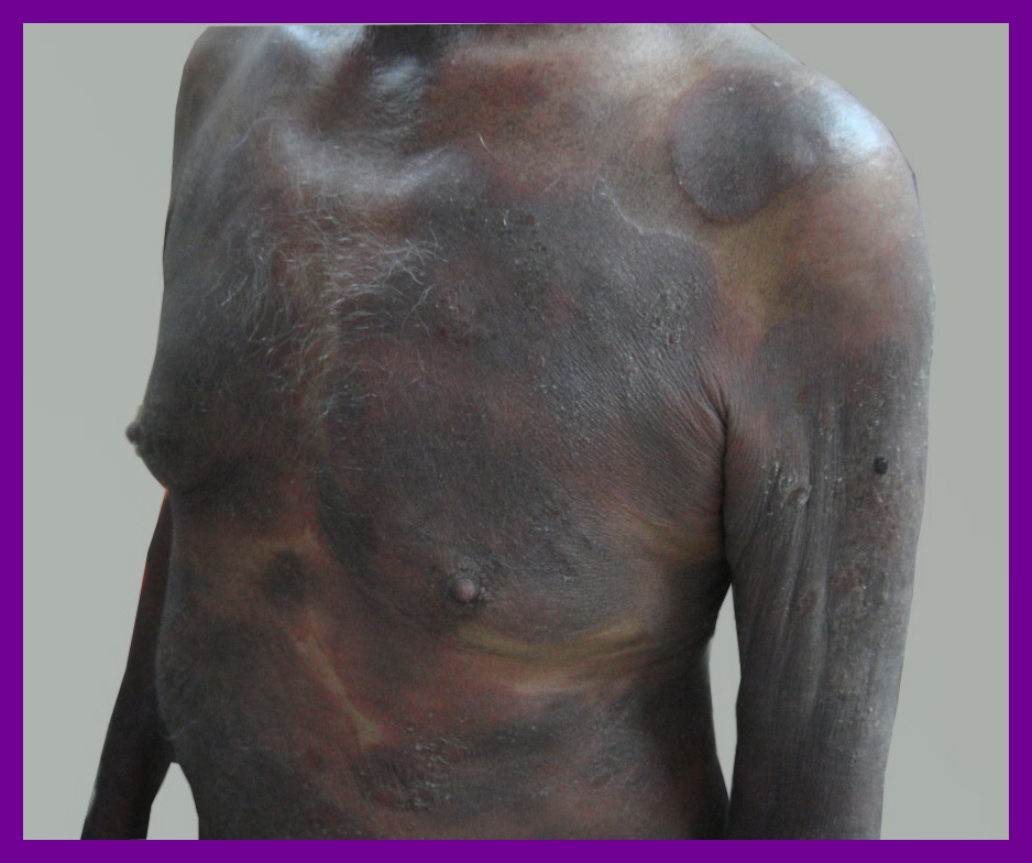 Skin Tumors: Mycosis fungoides (Plaque stage)