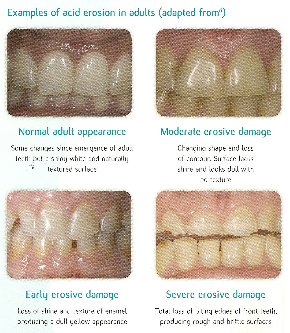 enamel damage front teeth