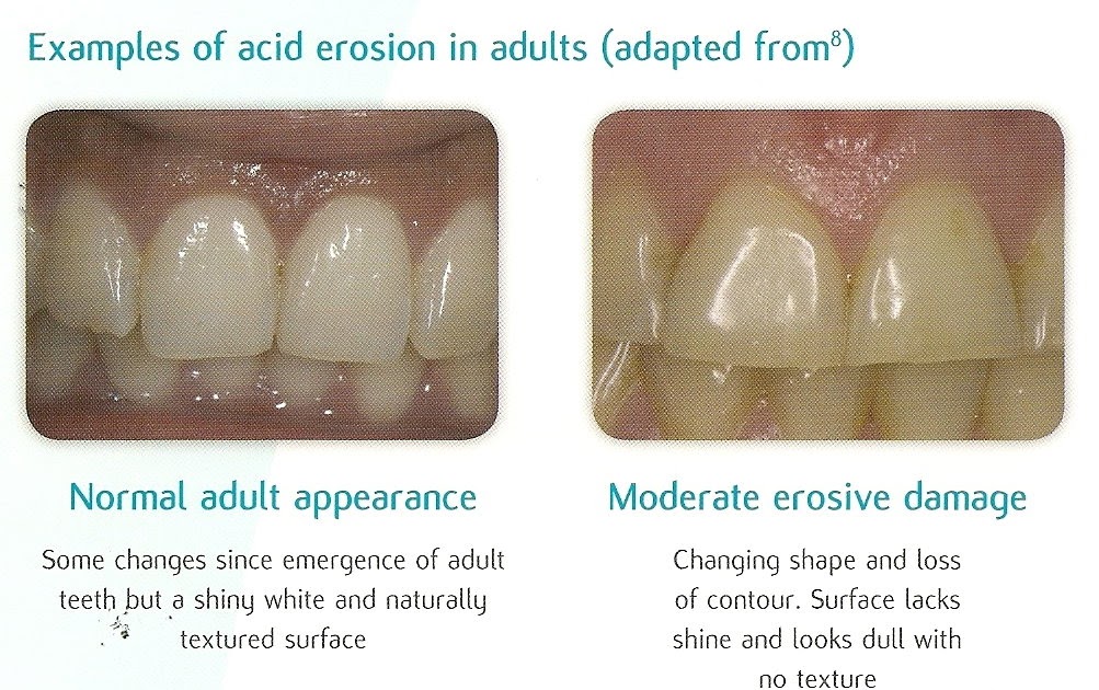 Making People Smile Tooth Erosion due to Acidic Foods