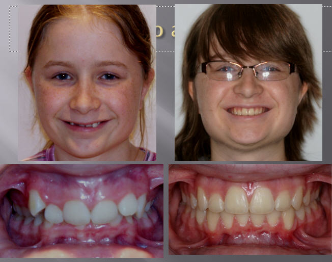 Dr William Thomas' Orthodontic Blog The Value of Damon Braces