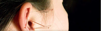 Acupunctura e Auriculopunctura