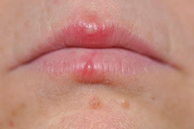 Wor Thamma How To Cure Herpes On Lips Bad To Squeeze Fluid Out Cold Sore Best Cold Sore Management And Treatments Options