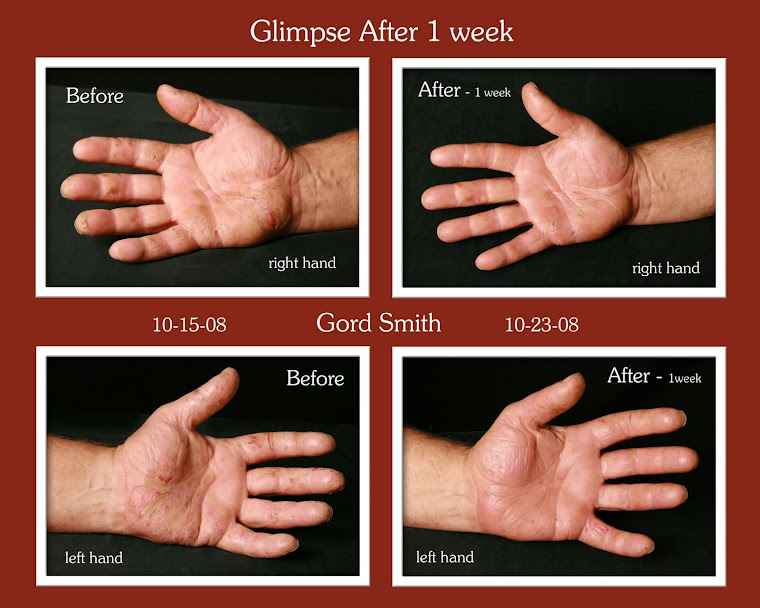 LOOK AT GORDON'S HANDS with just ONE WEEK of USING GLIMPSE!