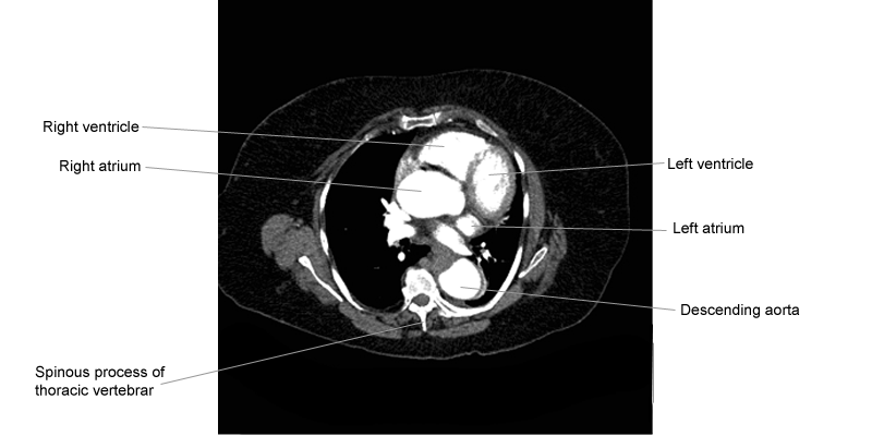 potongan axial ct scan thorax