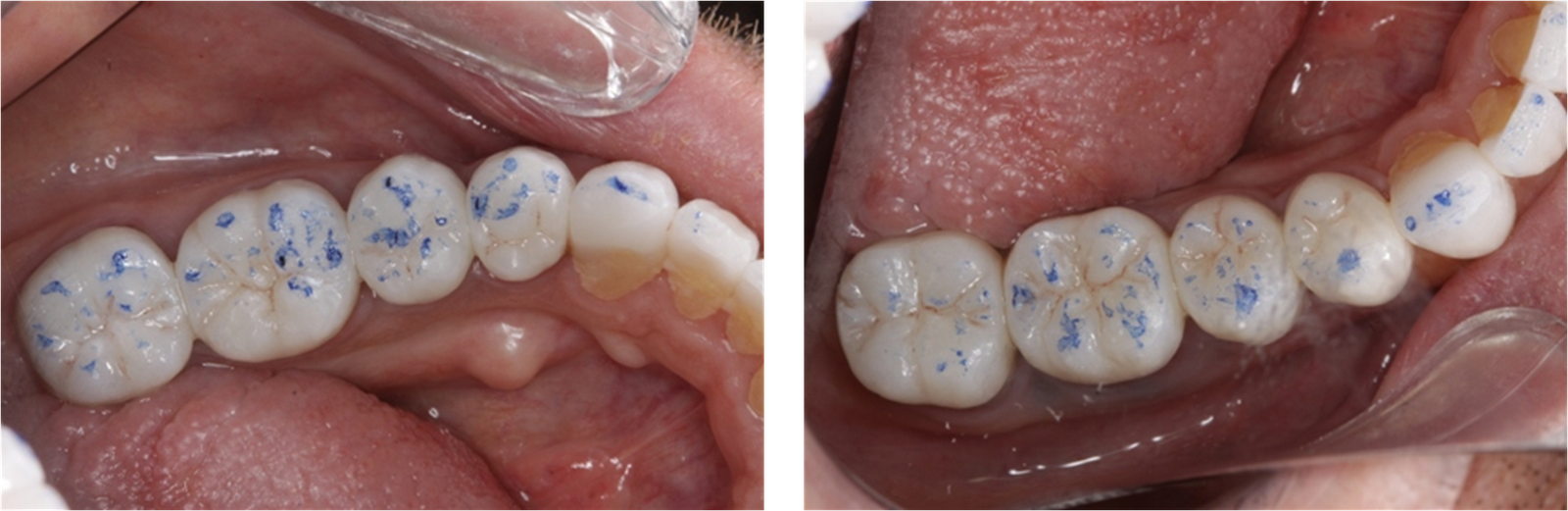 Dental Occlusion, Traumatic