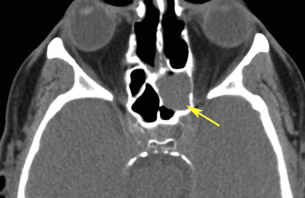 RiT radiology: Sphenoid Sinus Mucocele