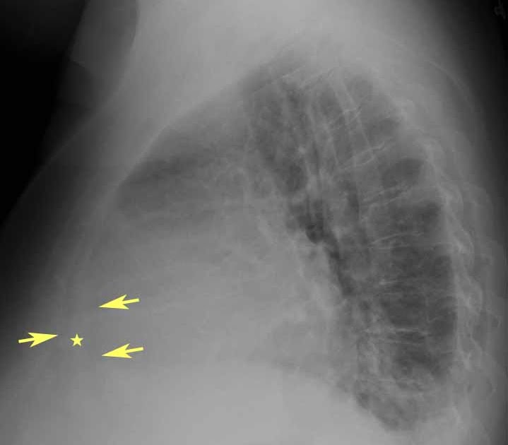 RiT radiology Pericardial Effusion on Lateral Chest Radiograph