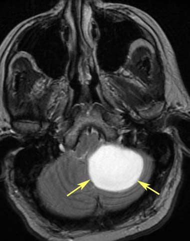 [hemangioblastoma+t2.jpg]