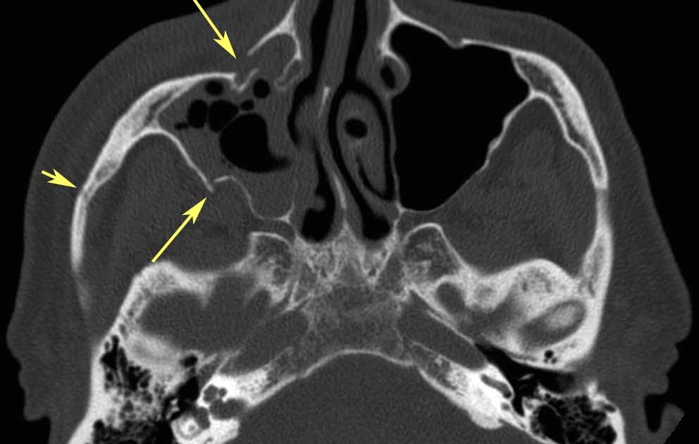 RiT radiology: Zygomaticomaxillary Complex (ZMC) Fracture
