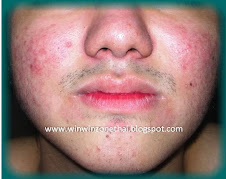 WinWinZone - FXprimus ThaiLand สุดยอดมหัศจรรย์สบู่แร่ Tourmaline เทคโนโลยีระดับนาโน