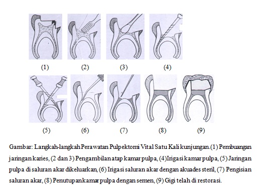 nekrosis pulpa | Catatan Si Bel