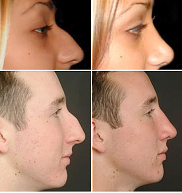 Trik Mudah Memancungkan Hidung [ www.BlogApaAja.com ]