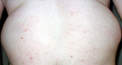 [bed-bug-bites-05.jpg]