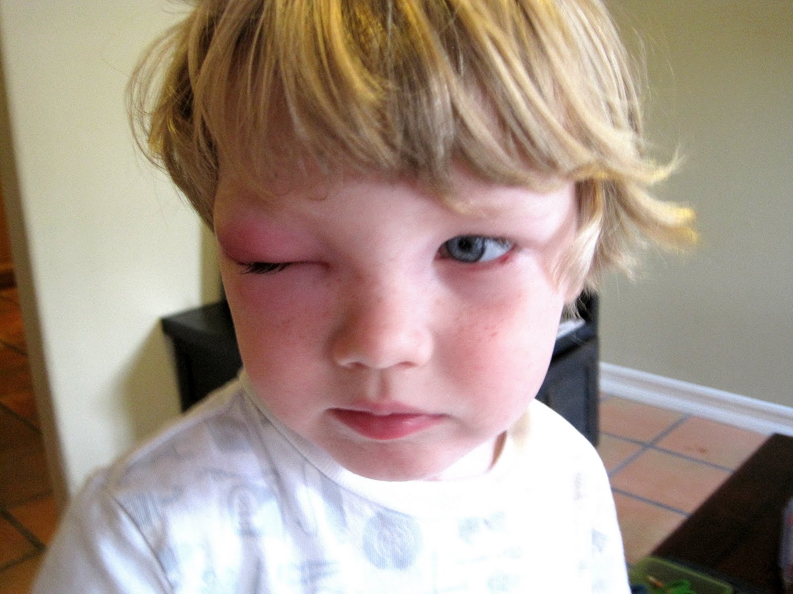 Pink Eye Pus