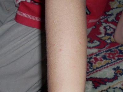 Breakthrough Chickenpox Pictures