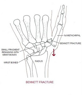 HiKaYaT PrinceSs: Bennet's Fracture