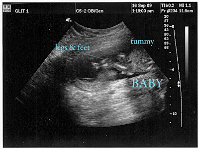 Sonogram 2 Weeks